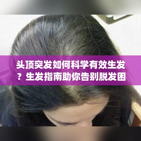 頭頂突發(fā)如何科學有效生發(fā)？生發(fā)指南助你告別脫發(fā)困擾！