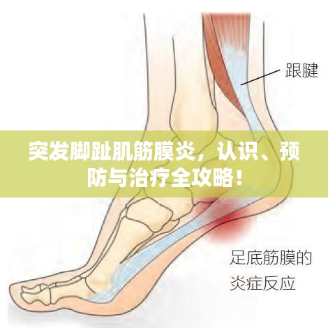 突發(fā)腳趾肌筋膜炎，認(rèn)識(shí)、預(yù)防與治療全攻略！